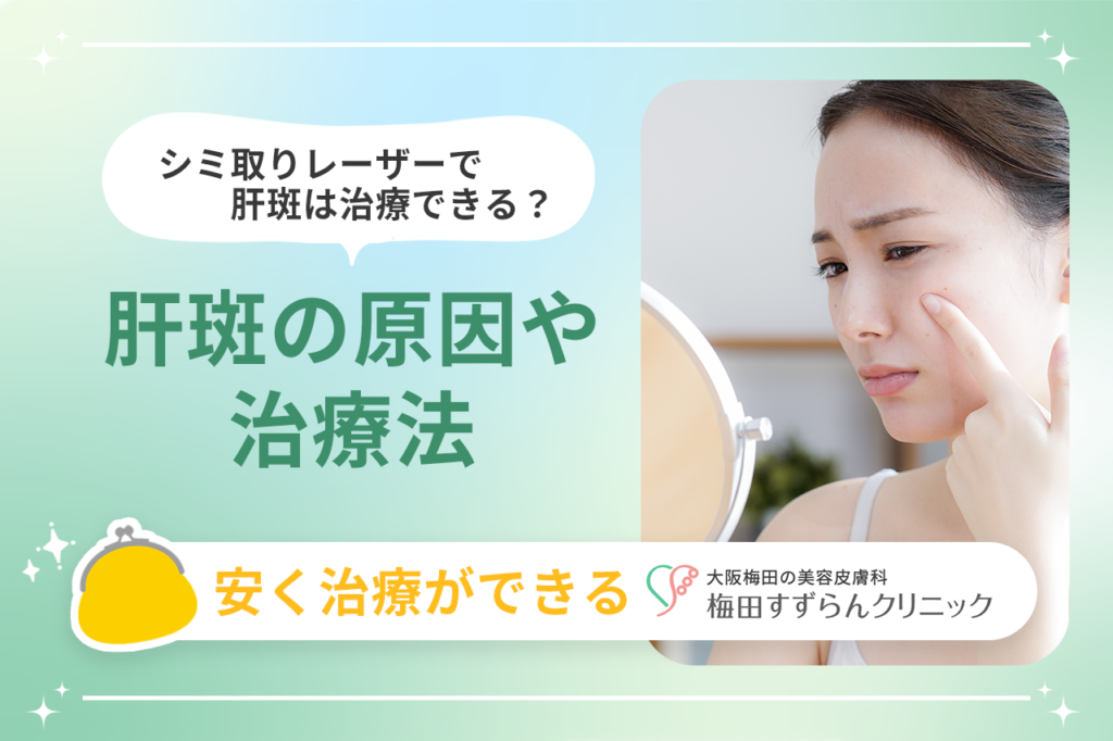 シミ取りレーザーで肝斑(かんぱん)は治療できる？肝斑の原因や治療法｜安く治療ができる【梅田すずらんクリニック】