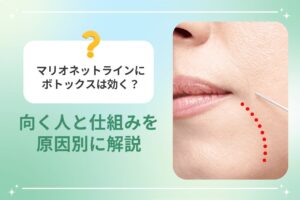 マリオネットラインにボトックスは効く？ 向く人と仕組みを原因別に解説