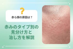 赤ら顔の原因は？赤みのタイプ別の見分け方と治し方を解説