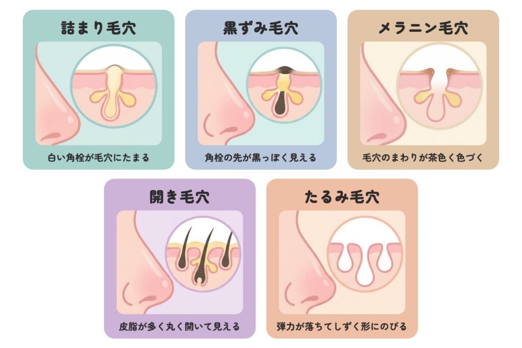 毛穴の種類
