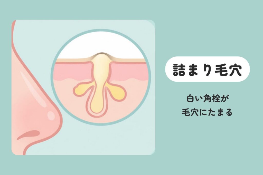 詰まり毛穴