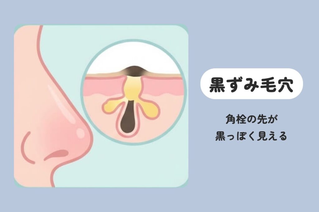 黒ずみ毛穴