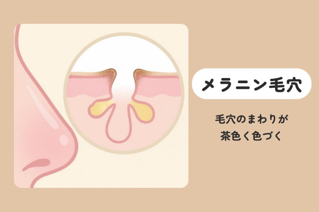 メラニン毛穴