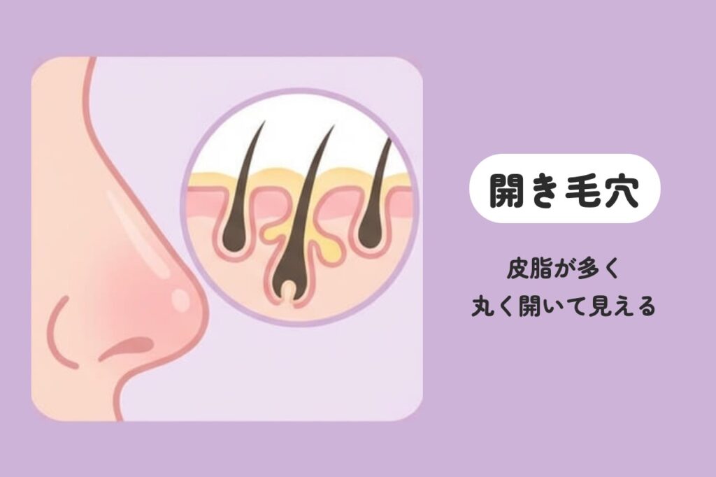 開き毛穴